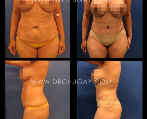 46yo female G2P2 (2 children) before and 4 months after abdominoplasty with liposuction of the flanks. A 7cm diastasis (muscle separation) was repaired. 4lb 4oz abdominal flap of tissue was removed. 2300cc of total aspirate was noted from the waist and flanks. Note: The patient has significant stretch marks above the belly button that could not fully be removed with the abdominoplasty procedure and was made aware of this limitation preop